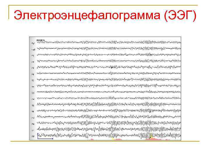 Электроэнцефалограмма (ЭЭГ) 