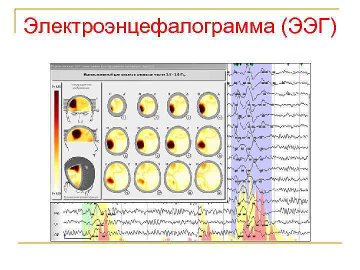 Электроэнцефалограмма (ЭЭГ) 