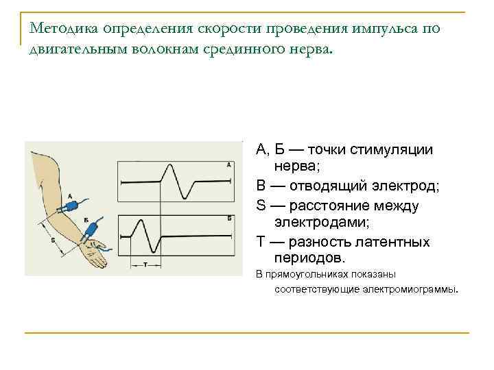 Методика определения скорости проведения импульса по двигательным волокнам срединного нерва. А, Б — точки