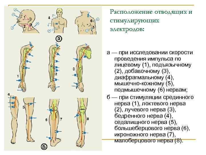 Расположение отводящих и стимулирующих электродов: а — при исследовании скорости проведения импульса по лицевому