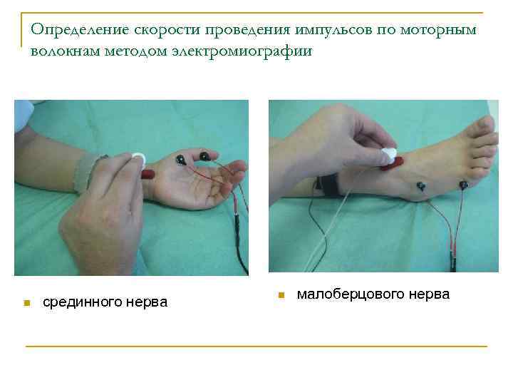 Определение скорости проведения импульсов по моторным волокнам методом электромиографии n срединного нерва n малоберцового