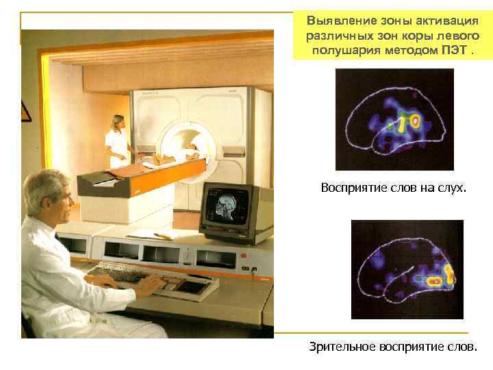 Выявление зоны активация различных зон коры левого полушария методом ПЭТ. Восприятие слов на слух.