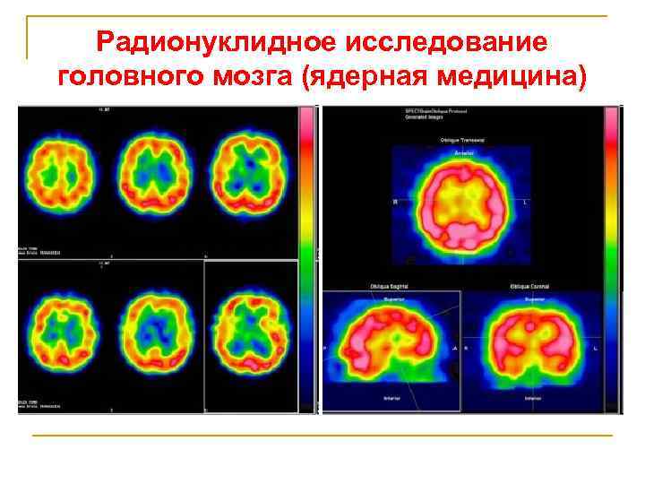 Исследование головного. Радионуклидное исследование. Радионуклидные методы исследования головного мозга. Методики радионуклидного исследования головного мозга. Сцинтиграфия головного мозга.