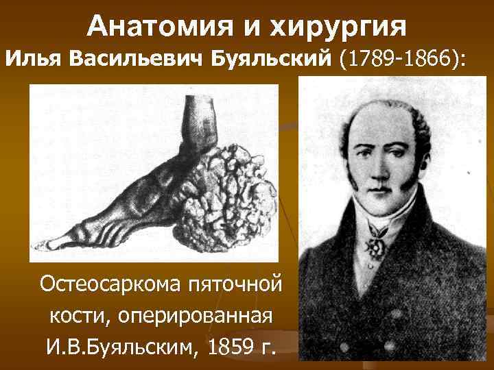 Анатомия и хирургия Илья Васильевич Буяльский (1789 -1866): Остеосаркома пяточной кости, оперированная И. В.