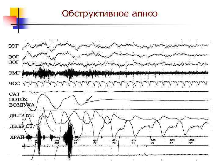 Обструктивное апноэ 