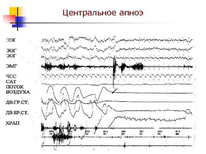 Центральное апноэ 