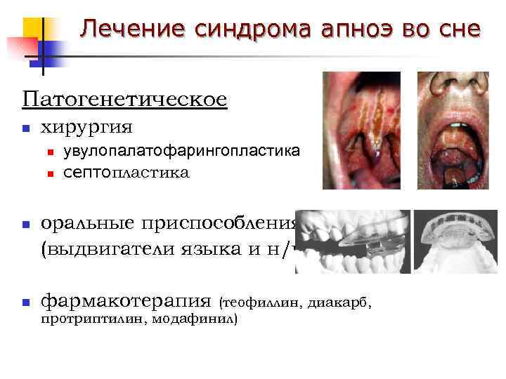 Лечение синдрома апноэ во сне Патогенетическое n хирургия n n увулопалатофарингопластика септопластика оральные приспособления