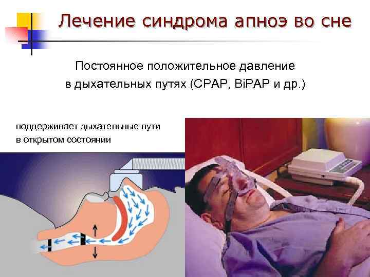 Лечение синдрома апноэ во сне Постоянное положительное давление в дыхательных путях (CPAP, Bi. PAP