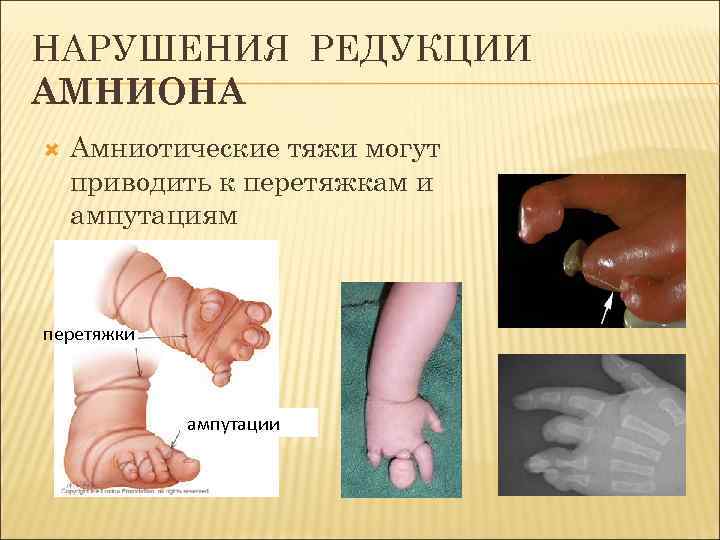 НАРУШЕНИЯ РЕДУКЦИИ АМНИОНА Амниотические тяжи могут приводить к перетяжкам и ампутациям перетяжки ампутации 