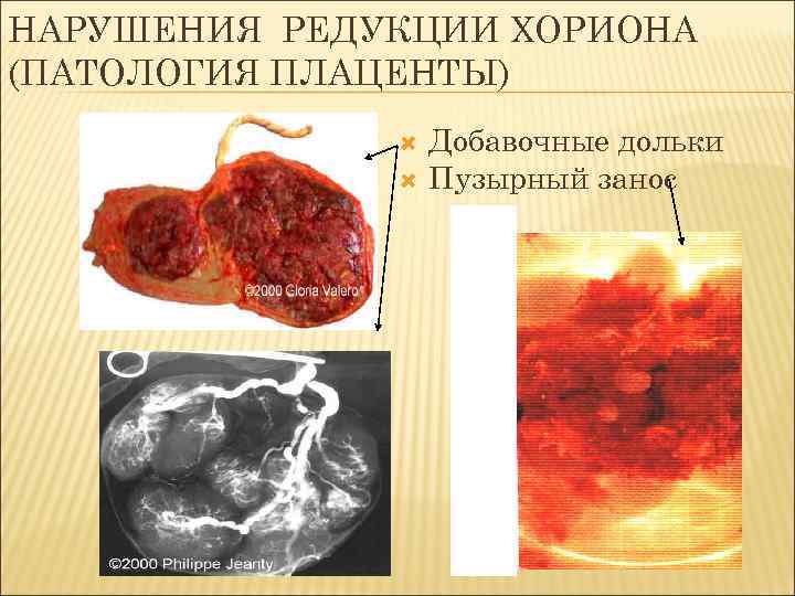 НАРУШЕНИЯ РЕДУКЦИИ ХОРИОНА (ПАТОЛОГИЯ ПЛАЦЕНТЫ) Добавочные дольки Пузырный занос 