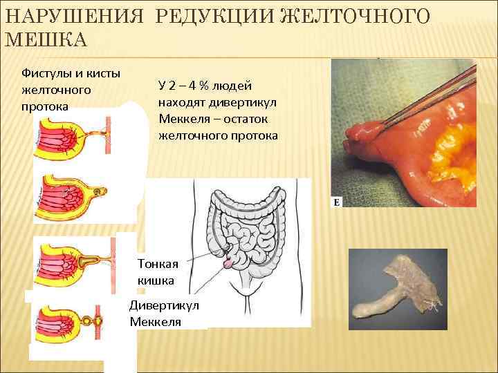 НАРУШЕНИЯ РЕДУКЦИИ ЖЕЛТОЧНОГО МЕШКА Фистулы и кисты желточного протока У 2 – 4 %