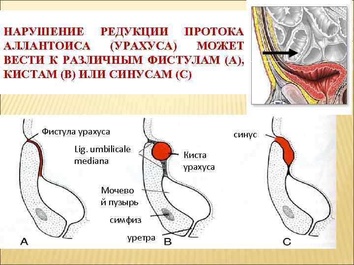 НАРУШЕНИЕ РЕДУКЦИИ ПРОТОКА АЛЛАНТОИСА (УРАХУСА) МОЖЕТ ВЕСТИ К РАЗЛИЧНЫМ ФИСТУЛАМ (А), КИСТАМ (В) ИЛИ