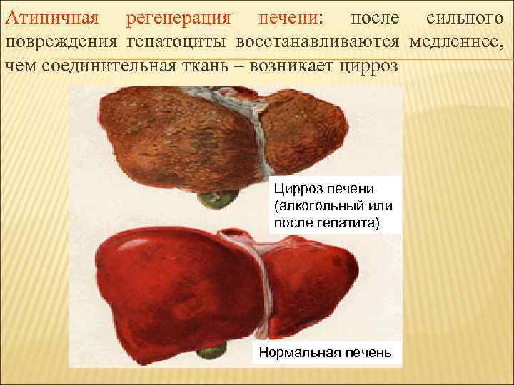 Атипичная регенерация печени: после сильного повреждения гепатоциты восстанавливаются медленнее, чем соединительная ткань – возникает