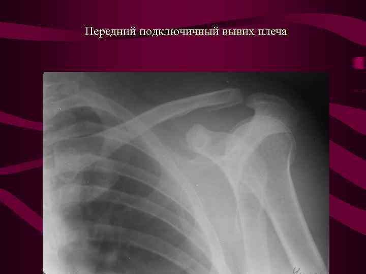 Вывих плеча мкб 10. Вывих плечевого сустава рентген. Задний вывих плечевого сустава рентген. Подвывих плечевого сустава рентген. Задний вывих головки плечевой кости рентген.