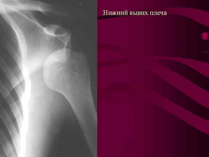Рассмотрите рентгенограмму с изображением плечевого сустава человека как называют повреждение