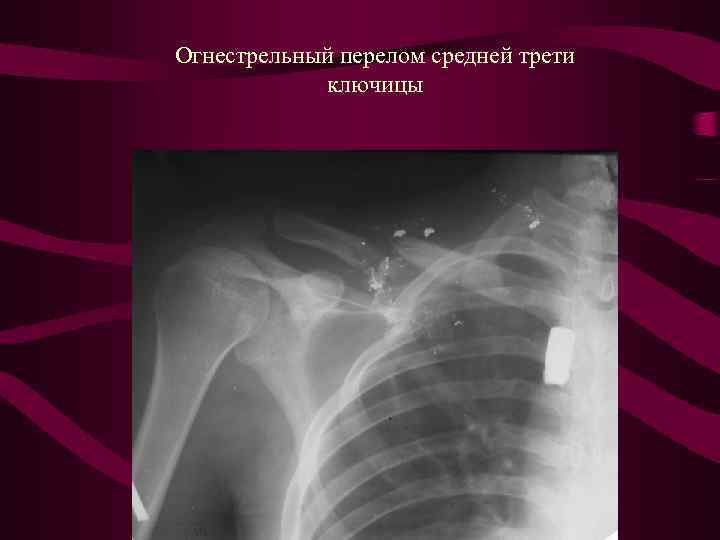 Ключица классификация. Перелом средней трети ключицы. Перелом ключицы средней трети без смещения. Оскольчатый перелом ключицы. Перелом средней трети ключицы со смещением отломков.