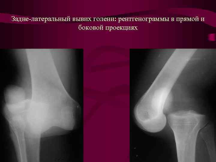 Рассмотрите рентгенограмму с изображением голени человека как называют повреждение которое