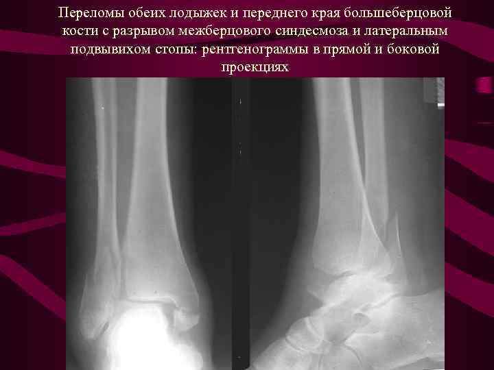Обеих костей. Краевой перелом большеберцовой кости голени. Перелом наружного края большеберцовой кости. Перелом задней большеберцовой кости. Перелом диафиза большеберцовой кости рентген.