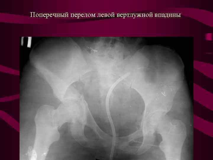 Перелом края вертлужной впадины. Перелом левой вертлужной впадины. Перелом задней колонны вертлужной впадины рентген. Перелом дна вертлужной впадины на рентгене. Перелом вертлужной впадины рентген.