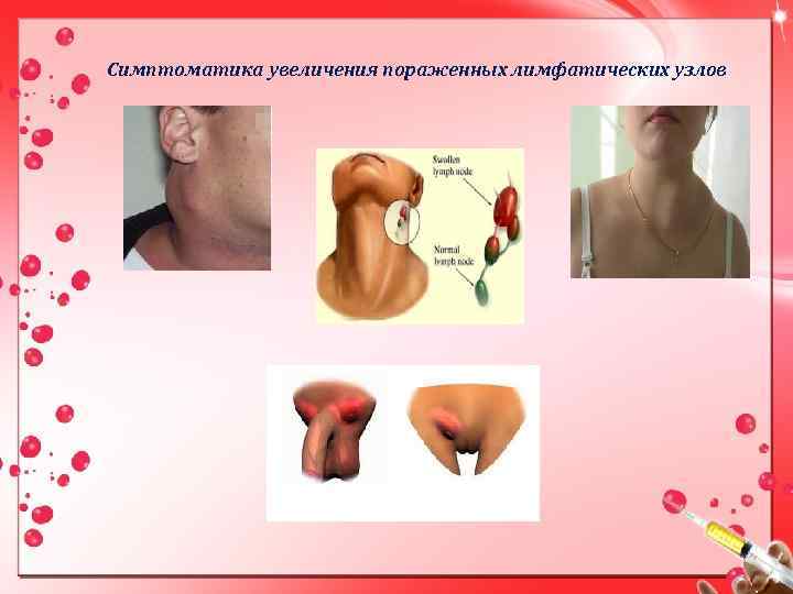 Симптоматика увеличения пораженных лимфатических узлов 