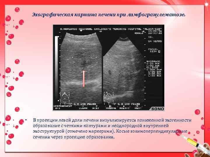 Эхографическая картина печени при лимфогранулематозе. • В проекции левой доли печени визуализируется пониженной эхогенности