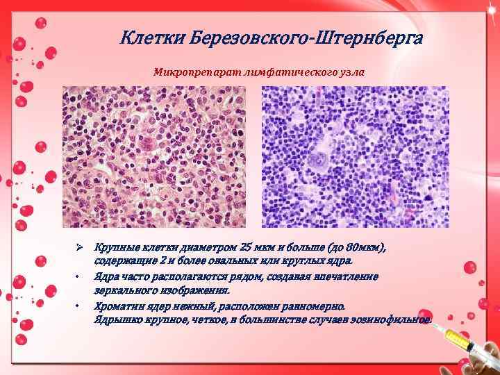 Клетки Березовского-Штернберга Микропрепарат лимфатического узла Ø Крупные клетки диаметром 25 мкм и больше (до