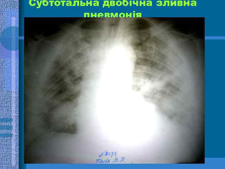 Субтотальна двобічна зливна пневмонія 