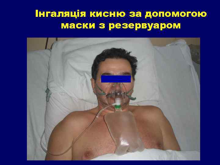 Інгаляція кисню за допомогою маски з резервуаром 