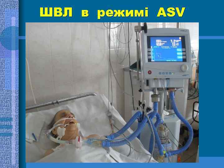 ШВЛ в режимі ASV 
