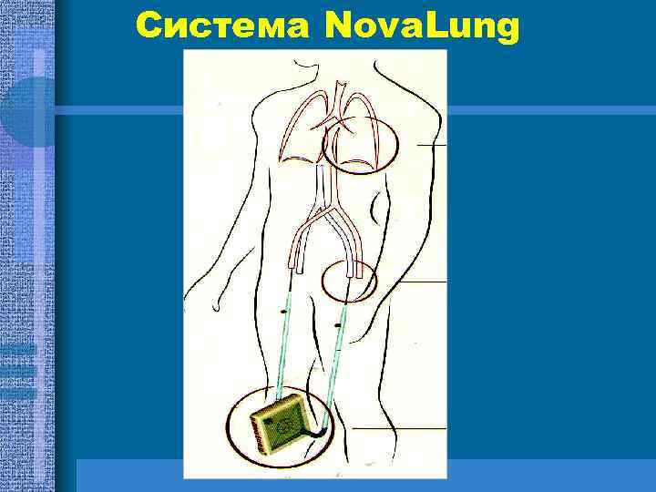 Система Nova. Lung 