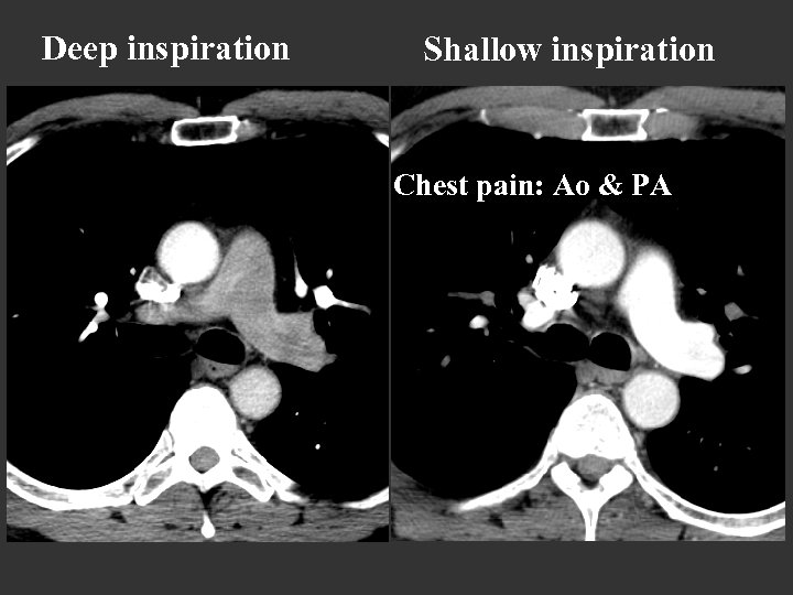Deep inspiration Shallow inspiration Chest pain: Ao & PA 