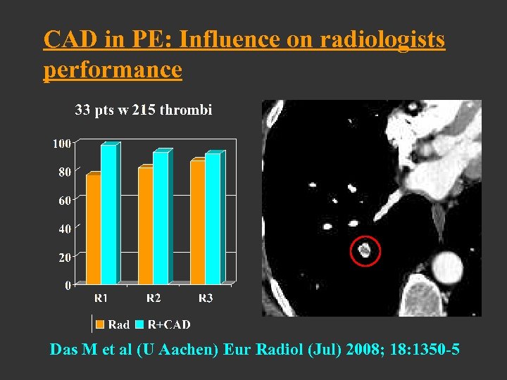 CAD in PE: Influence on radiologists performance Das M et al (U Aachen) Eur