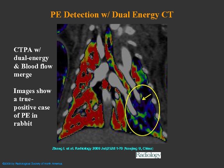 PE Detection w/ Dual Energy CT CTPA w/ dual-energy & Blood flow merge Images