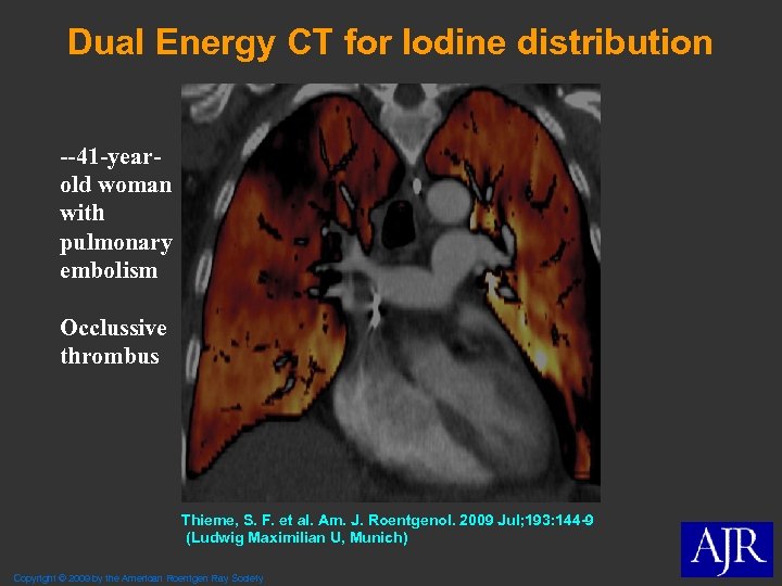 Dual Energy CT for Iodine distribution --41 -yearold woman with pulmonary embolism Occlussive thrombus