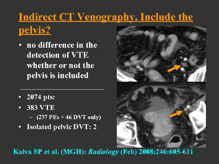 Indirect CT Venography. Include the pelvis? • no difference in the detection of VTE
