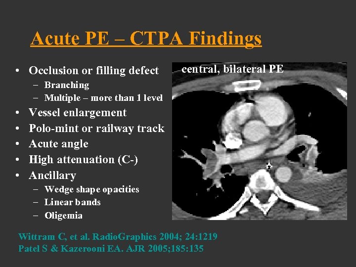 Acute PE – CTPA Findings • Occlusion or filling defect central, bilateral PE –