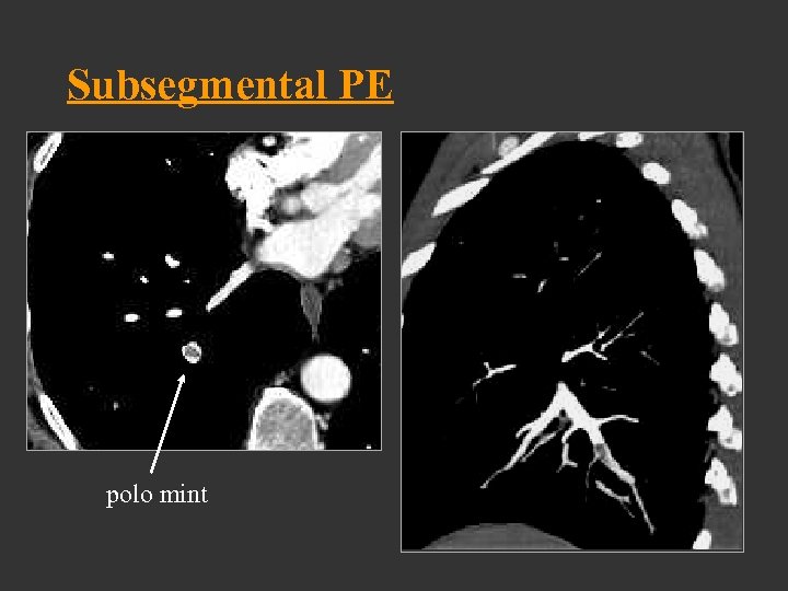 Subsegmental PE polo mint 