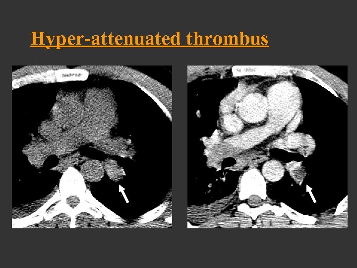 Hyper-attenuated thrombus 
