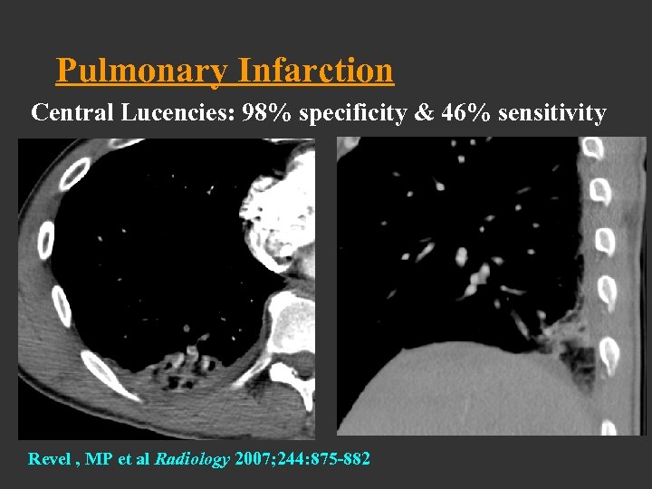Pulmonary Infarction Central Lucencies: 98% specificity & 46% sensitivity Revel , MP et al