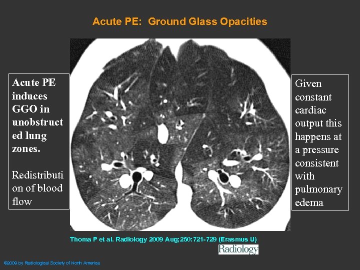 Acute PE: Ground Glass Opacities Acute PE induces GGO in unobstruct ed lung zones.