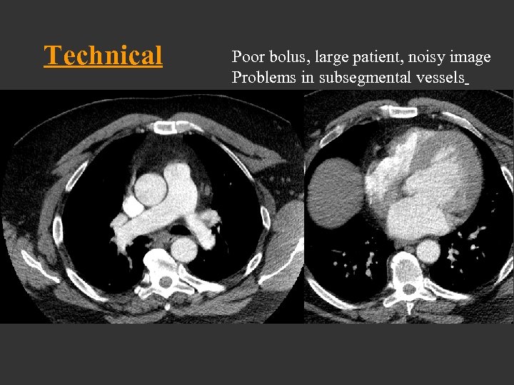Technical Poor bolus, large patient, noisy image Problems in subsegmental vessels 