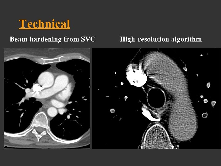 Technical Beam hardening from SVC High-resolution algorithm 
