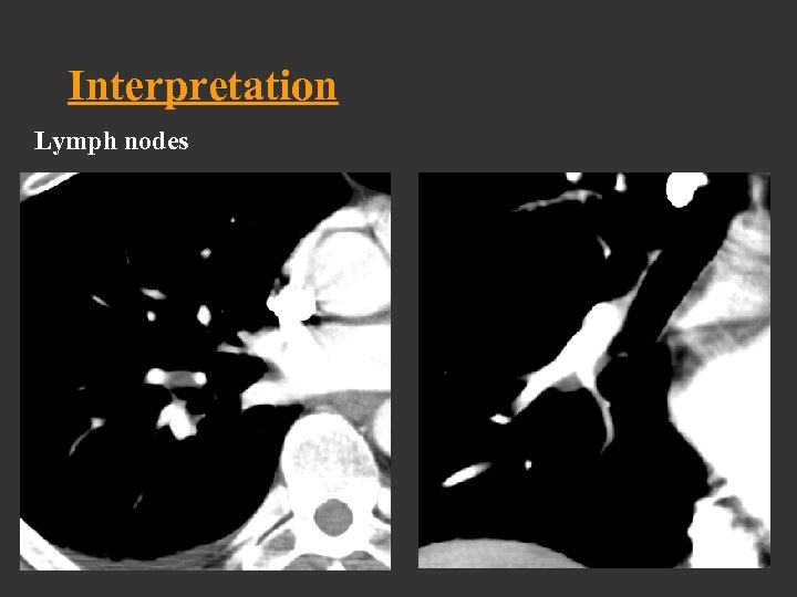 Interpretation Lymph nodes 