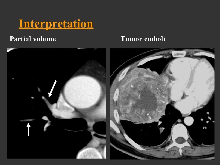 Interpretation Partial volume Tumor emboli 