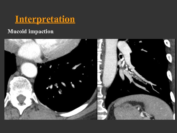 Interpretation Mucoid impaction 