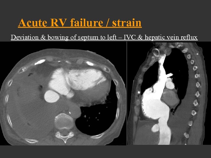 Acute RV failure / strain Deviation & bowing of septum to left – IVC