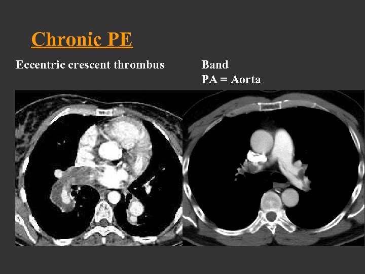 Chronic PE Eccentric crescent thrombus Band PA = Aorta 