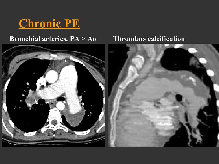 Chronic PE Bronchial arteries, PA > Ao Thrombus calcification 