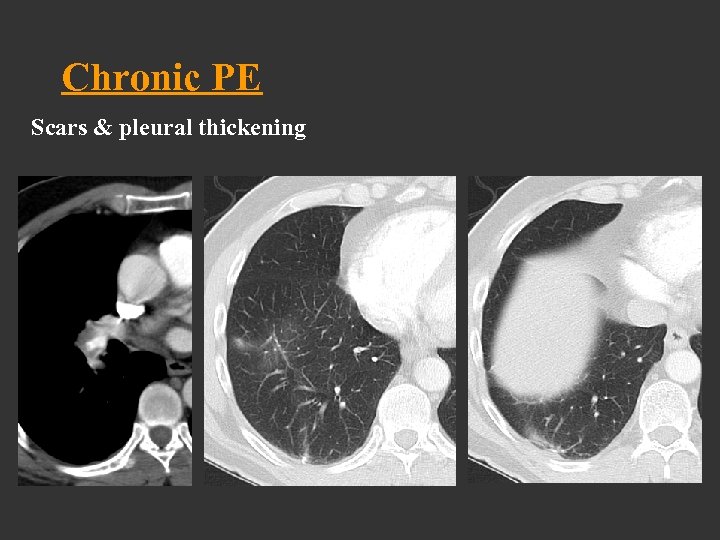 Chronic PE Scars & pleural thickening 