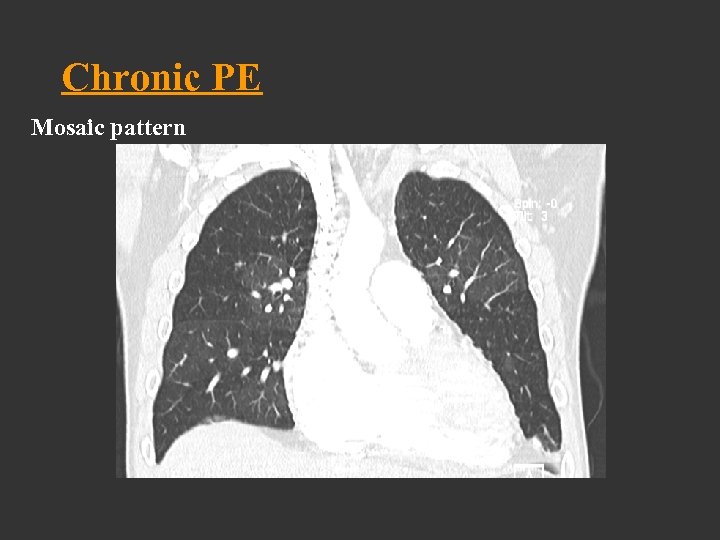 Chronic PE Mosaic pattern 
